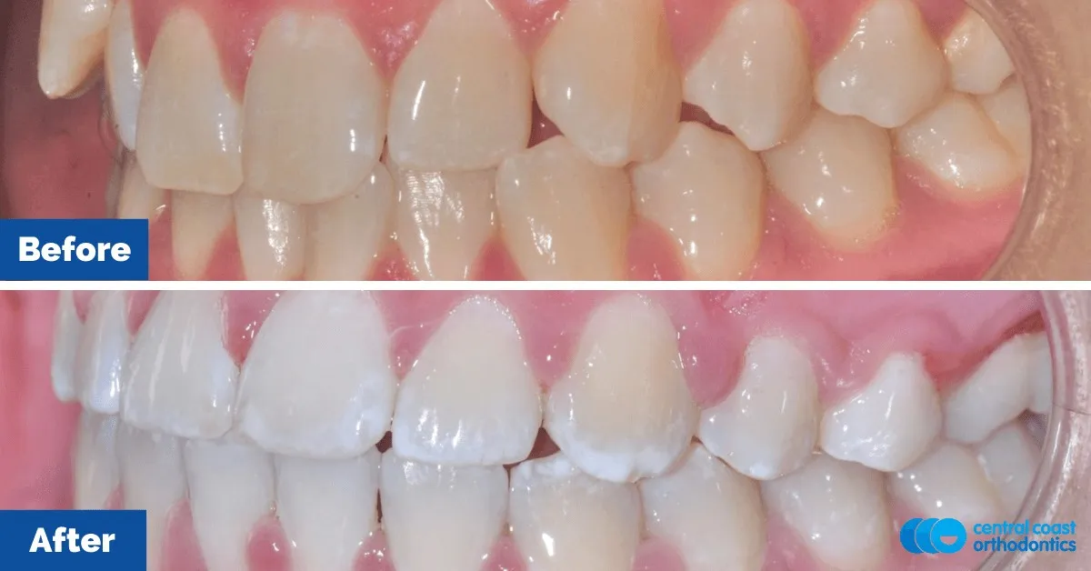 Before and after comparison, side view of the upper and lower teeth