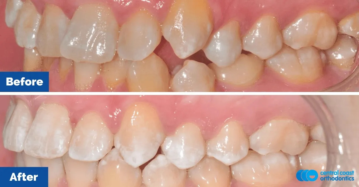 Before and after comparison, side view of the upper and lower teeth