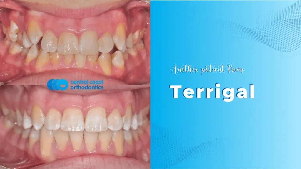 Before and after photographs of a Central Coast Orthodontics patient's teeth, labelled Terrigal