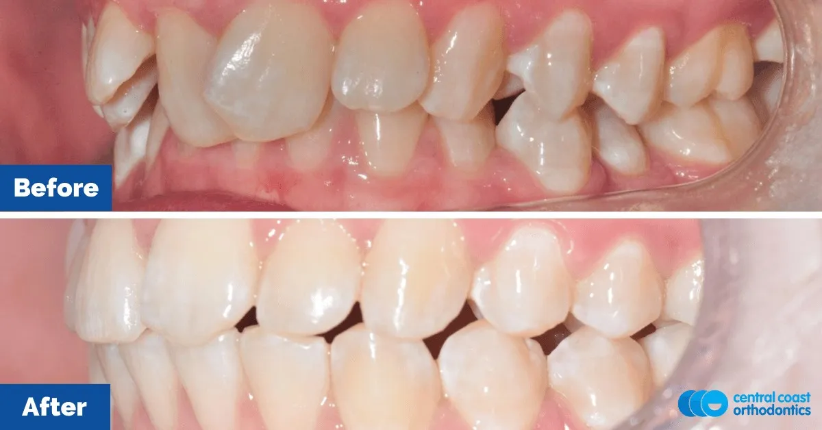 Before and after comparison, side view of the upper and lower teeth