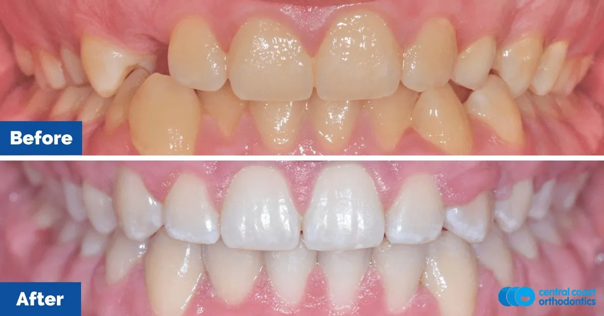 Before and after comparison, front view of the upper and lower teeth