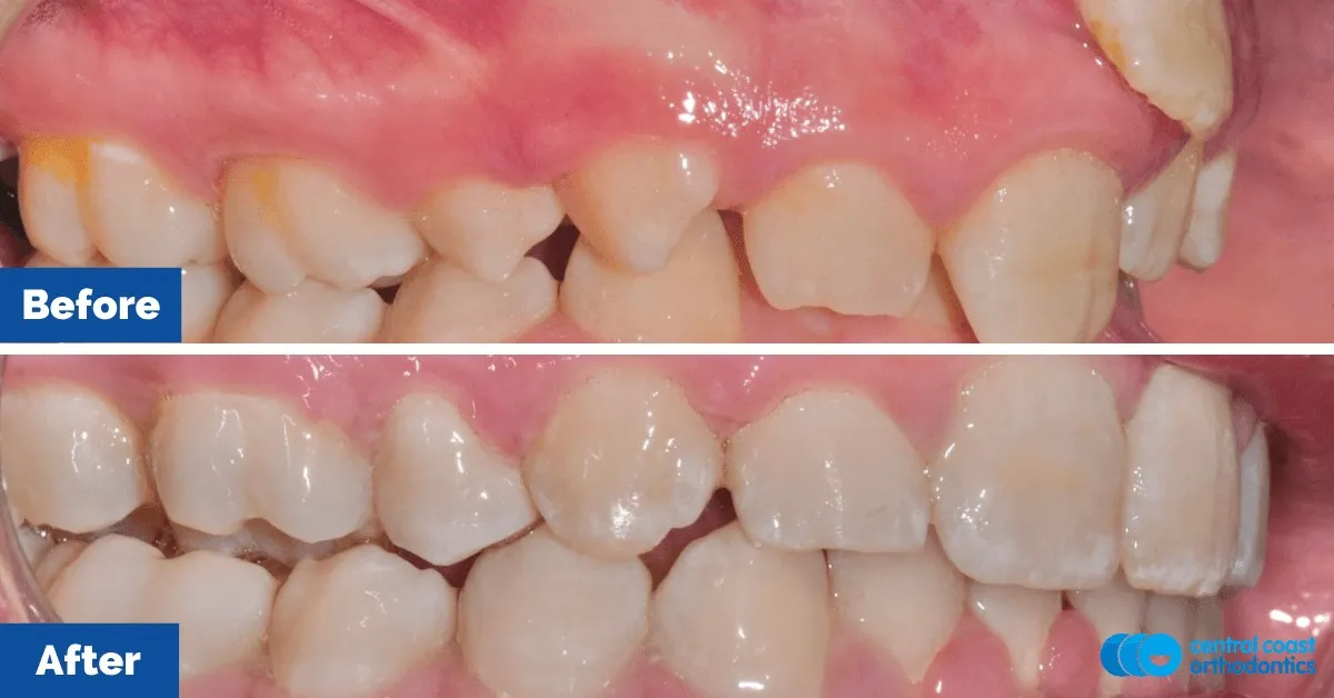 Before and after comparison, side view of the upper and lower teeth