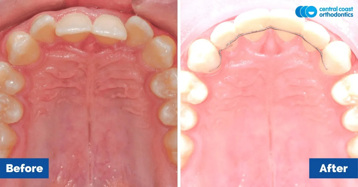 Before and after comparison, upper teeth viewed from below