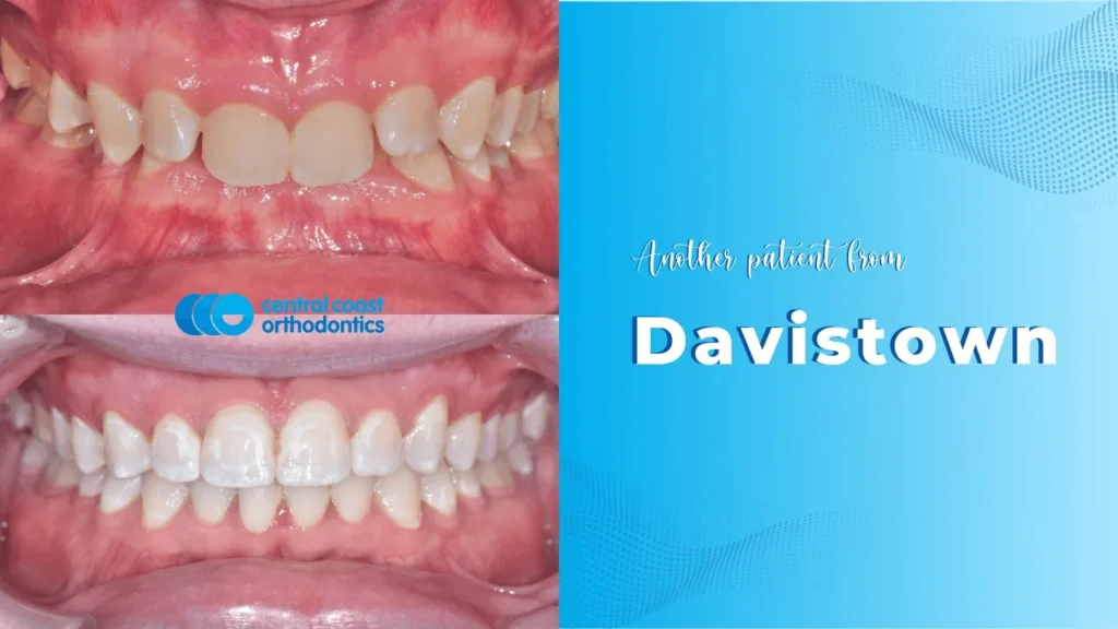 Before and after photographs of a Central Coast Orthodontics patient's teeth, labelled Davistown