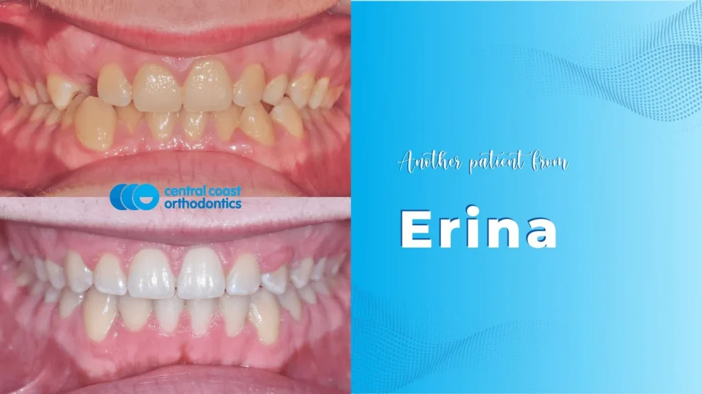 Before and after photographs of a Central Coast Orthodontics patient's teeth, labelled Erina