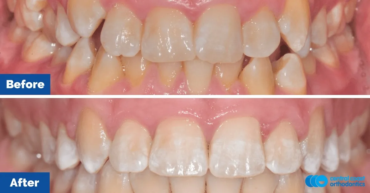 Before and after comparison, front view of the upper and lower teeth