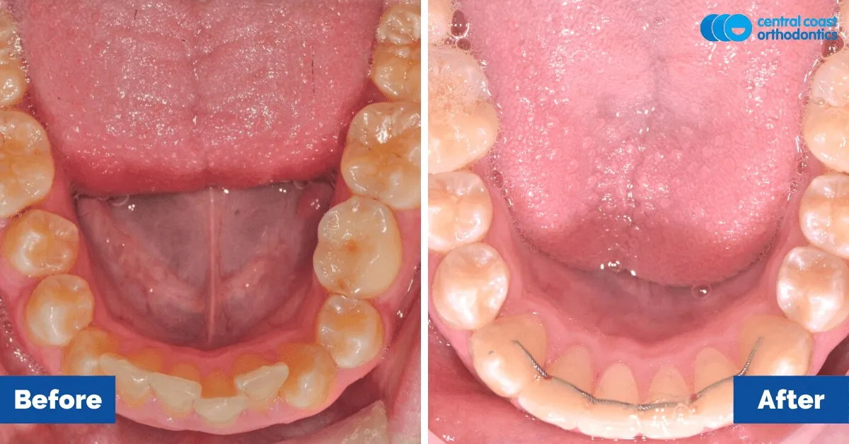 Before and after comparison, lower teeth viewed from above
