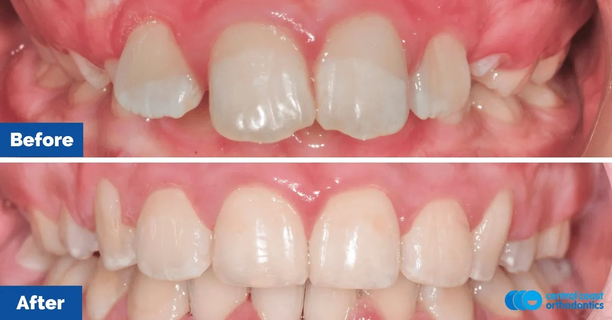 Before and after comparison, side view of the upper and lower teeth