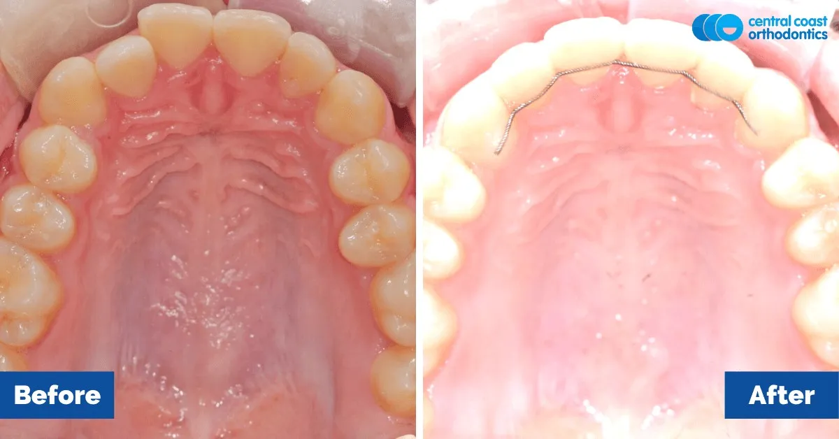 Before and after comparison, upper teeth viewed from below
