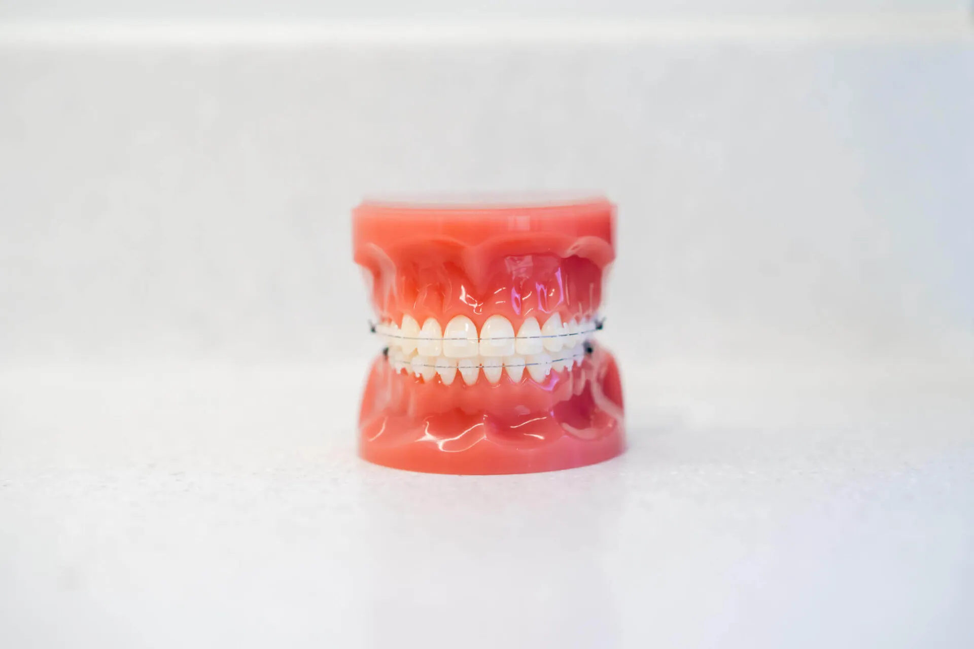 Dental model fitted with fixed braces on upper and lower teeth