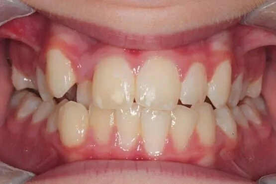 Close-up of a patient's crowded and uneven upper and lower front teeth before orthodontic treatment