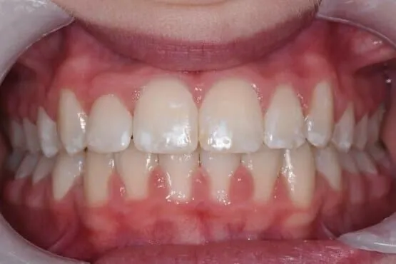 The same patient's evenly aligned upper and lower front teeth after orthodontic treatment
