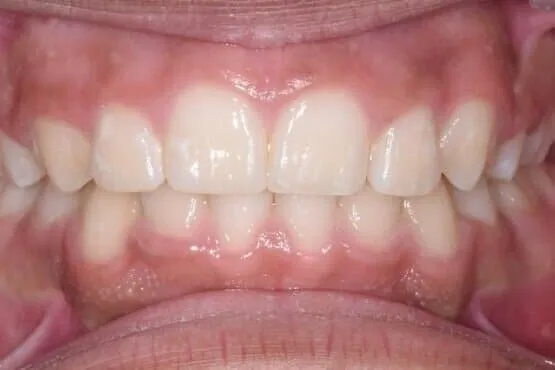The same patient's straightened upper and lower front teeth after orthodontic treatment