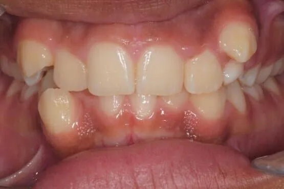 Close-up of overlapping upper front teeth with an uneven bite before orthodontic treatment