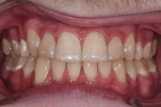 The same patient's canine brought into line and front teeth aligned after orthodontic treatment