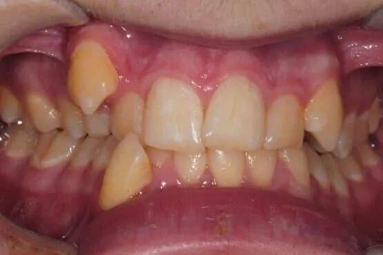 Close-up of a high, out-of-line upper canine and crowded front teeth before orthodontic treatment