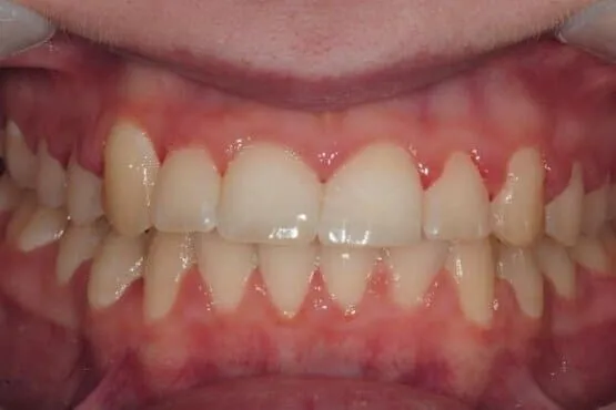 The same patient's upper canine and front teeth evenly aligned after orthodontic treatment