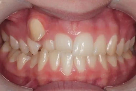 Close-up of a displaced upper canine sitting above the arch before orthodontic treatment