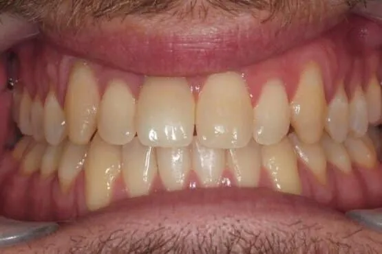 The same patient's upper and lower front teeth aligned after orthodontic treatment