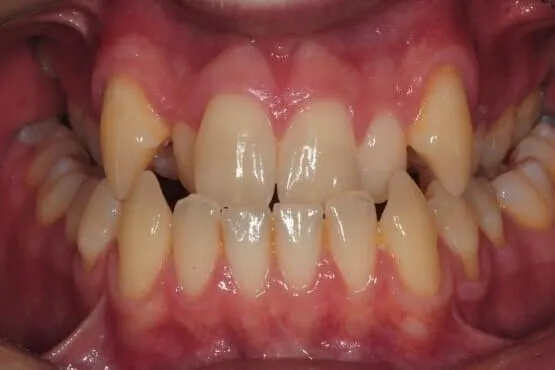 Close-up of crowded, overlapping upper and lower front teeth before orthodontic treatment