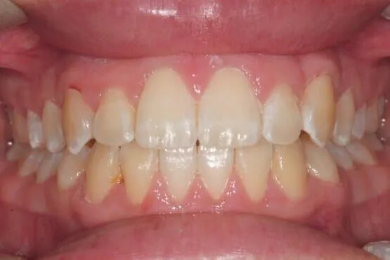 The same patient's aligned front teeth after orthodontic treatment