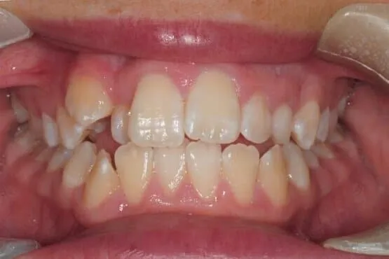 Close-up of crowded front teeth with a protruding upper canine before orthodontic treatment