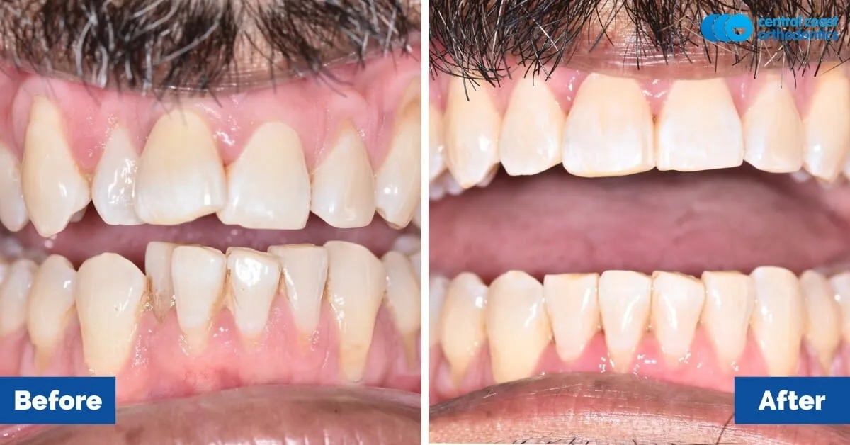 Before and after comparison, front view of the upper and lower teeth