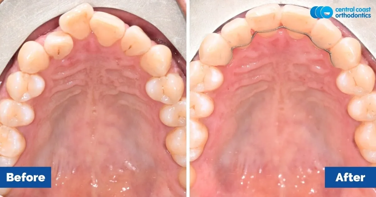 Before and after comparison, upper teeth viewed from below
