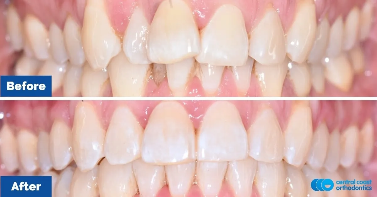 Before and after comparison, front view of the upper and lower teeth