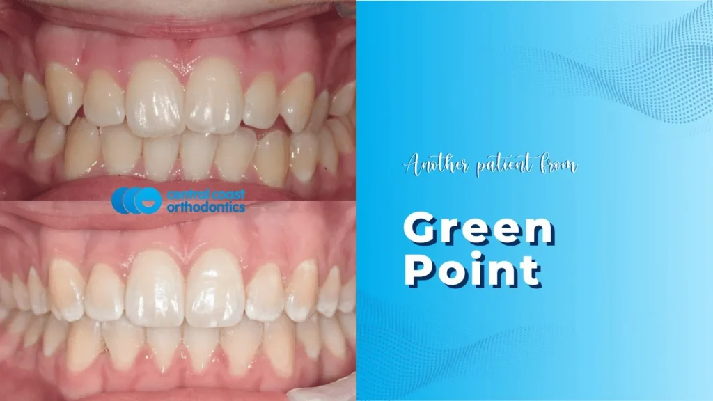 Before and after photographs of a Central Coast Orthodontics patient's teeth, labelled Green Point
