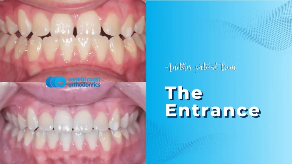 Before and after photographs of a Central Coast Orthodontics patient's teeth, labelled The Entrance