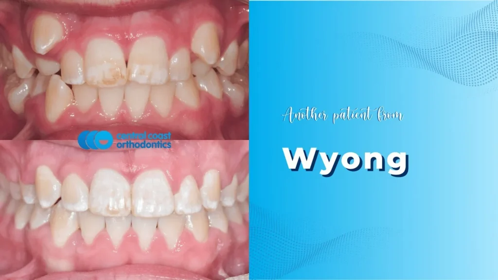 Before and after photographs of a Central Coast Orthodontics patient's teeth, labelled Wyong