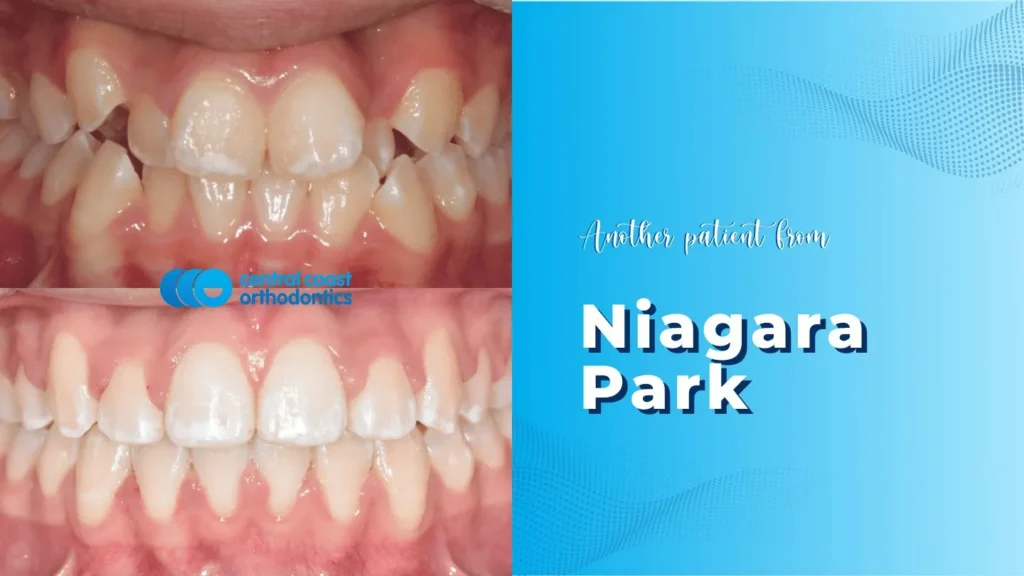 Before and after photographs of a Central Coast Orthodontics patient's teeth, labelled Niagara Park