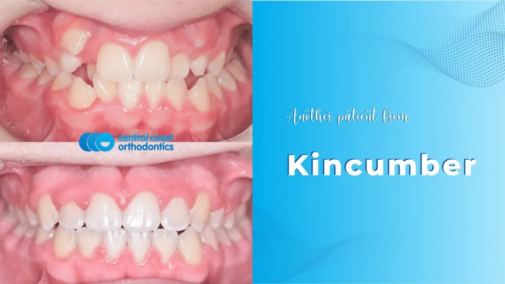 Before and after photographs of a Central Coast Orthodontics patient's teeth, labelled Kincumber