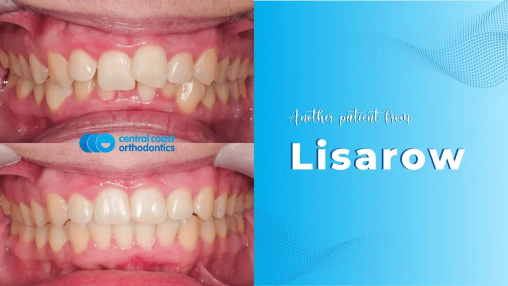 Before and after photographs of a Central Coast Orthodontics patient's teeth, labelled Lisarow