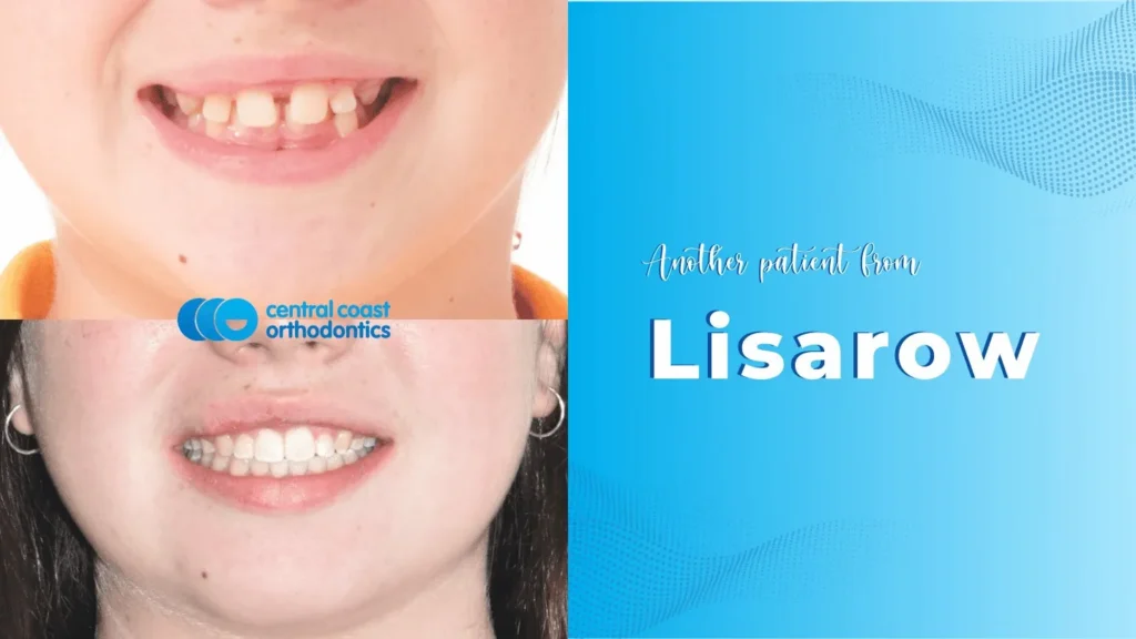Close-up of a smile beside a Central Coast Orthodontics patient card labelled Lisarow