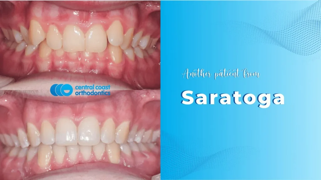 Before and after photographs of a Central Coast Orthodontics patient's teeth, labelled Saratoga