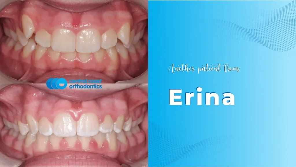 Before and after photographs of a Central Coast Orthodontics patient's teeth, labelled Erina
