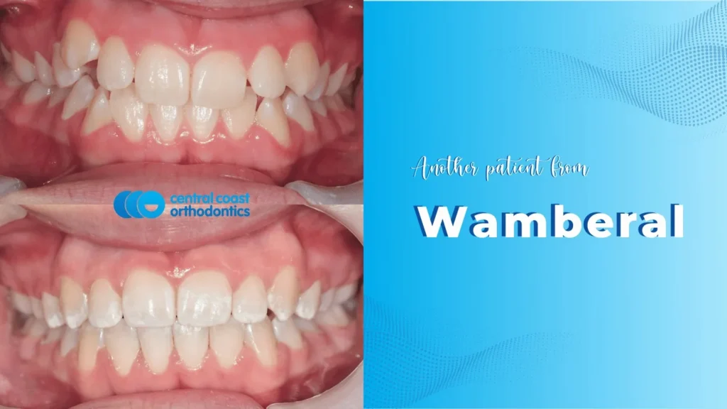 Before and after photographs of a Central Coast Orthodontics patient's teeth, labelled Wamberal