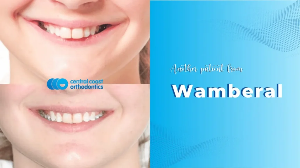 Before and after photographs of a Central Coast Orthodontics patient's smile, labelled Wamberal