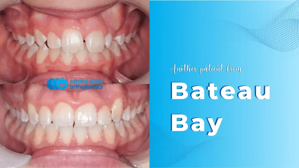 Before and after photographs of a Central Coast Orthodontics patient's teeth, labelled Bateau Bay
