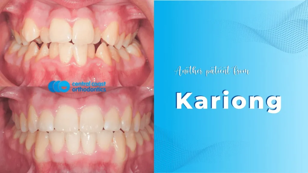 Before and after photographs of a Central Coast Orthodontics patient's teeth, labelled Kariong