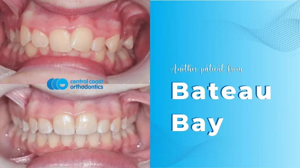 Before and after photographs of a Central Coast Orthodontics patient's teeth, labelled Bateau Bay