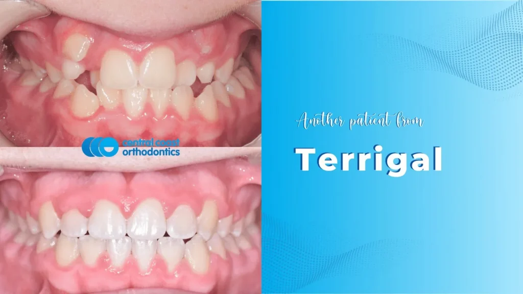 Before and after photographs of a Central Coast Orthodontics patient's teeth, labelled Terrigal