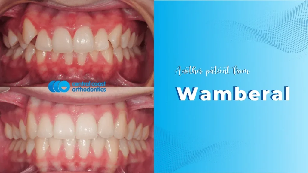 Before and after photographs of a Central Coast Orthodontics patient's teeth, labelled Wamberal