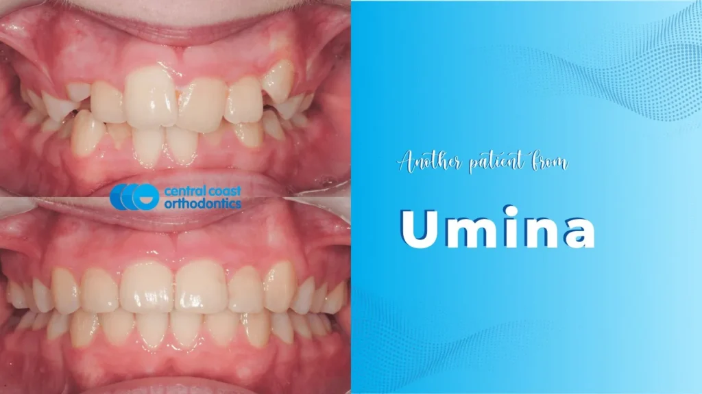 Before and after photographs of a Central Coast Orthodontics patient's teeth, labelled Umina