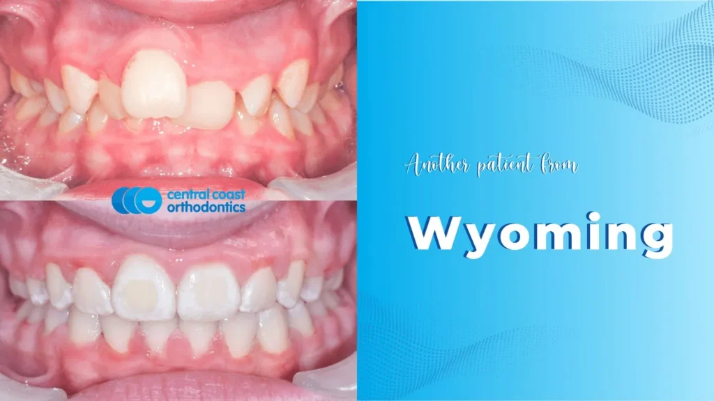 Before and after photographs of a Central Coast Orthodontics patient's teeth, labelled Wyoming