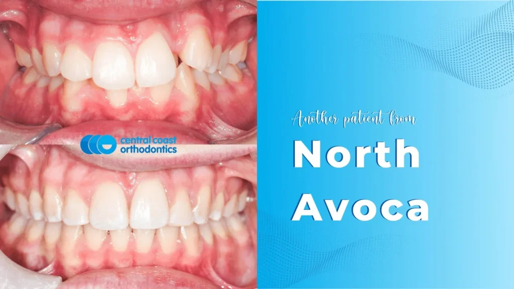 Before and after photographs of a Central Coast Orthodontics patient's teeth, labelled North Avoca
