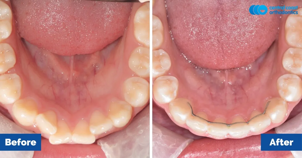 Before and after comparison, lower teeth viewed from above