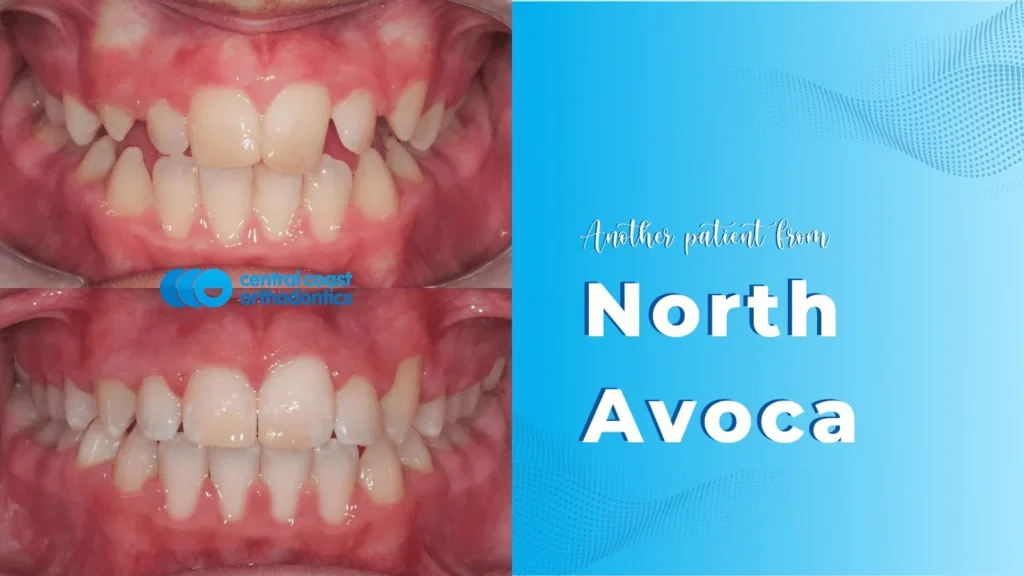 Before and after photographs of a Central Coast Orthodontics patient's teeth, labelled North Avoca